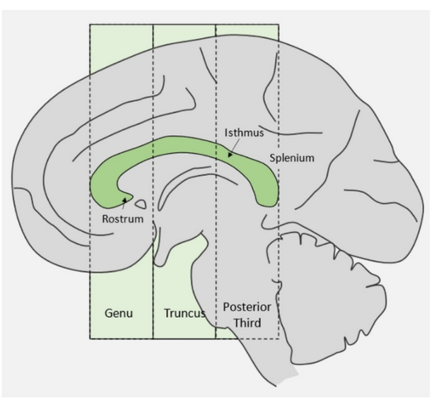 The brain hemispheres are not better connected in left handers